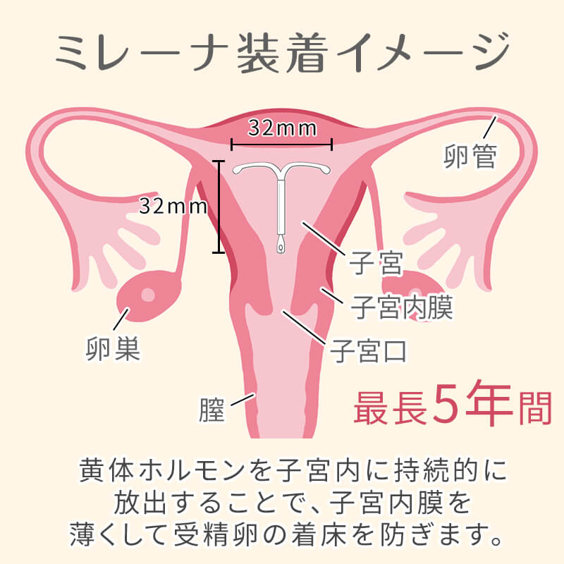 ミレーナ